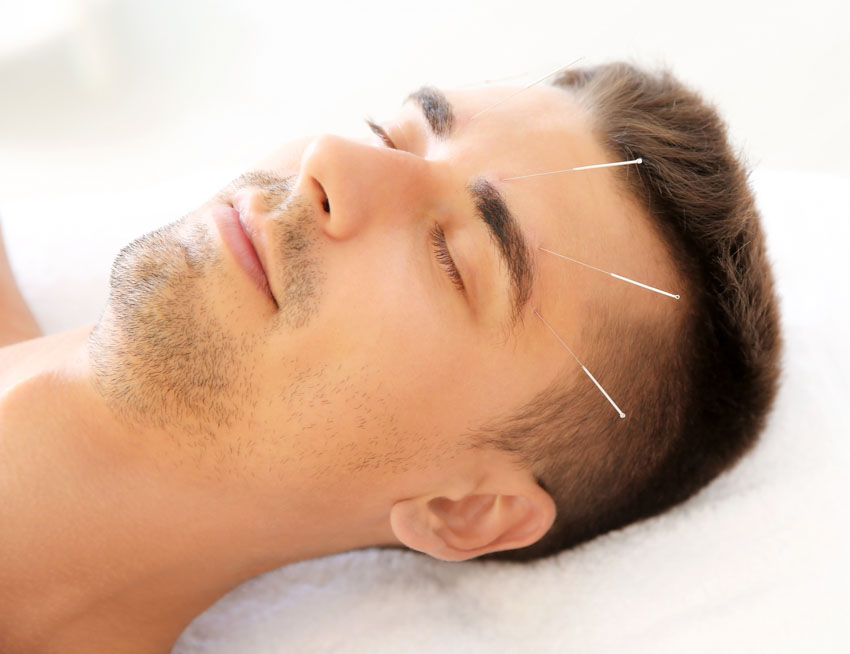 acupuncture migraine