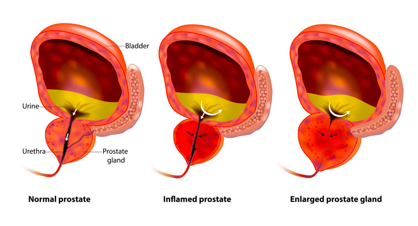 acupuncture prostate tx