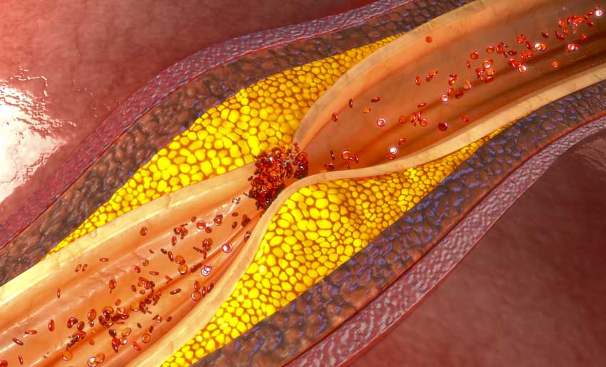 coronary artery