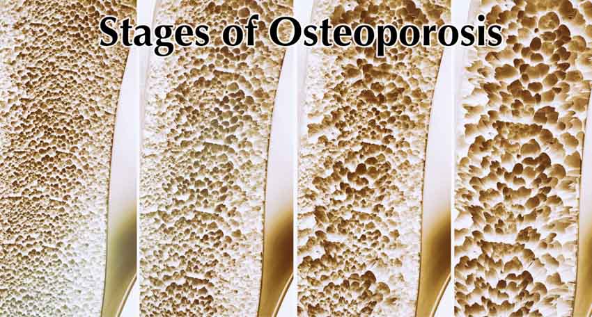 osteoporosis