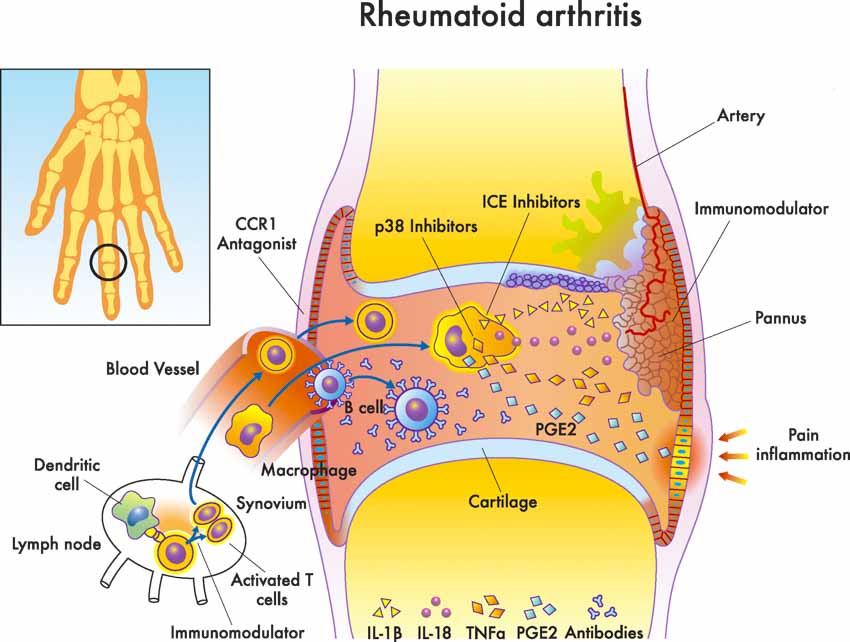 rheumatoid arthritis