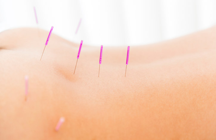 Lower Back Needles