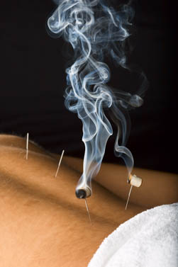 Moxibustion on the bladder meridian. 