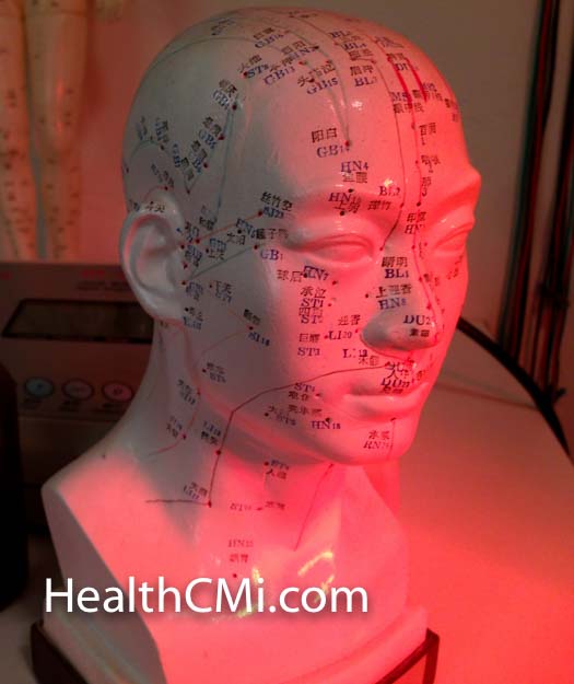 Scalp points for needling a stroke patient. 