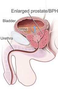 Enlarged prostates are treated with acupuncture points.